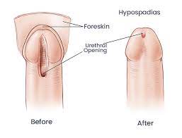 After Hypospadias Surgery