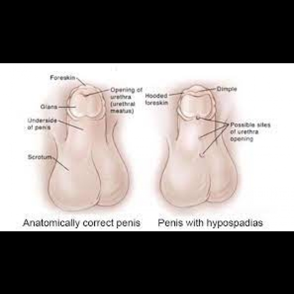 Penis with Hypospadias